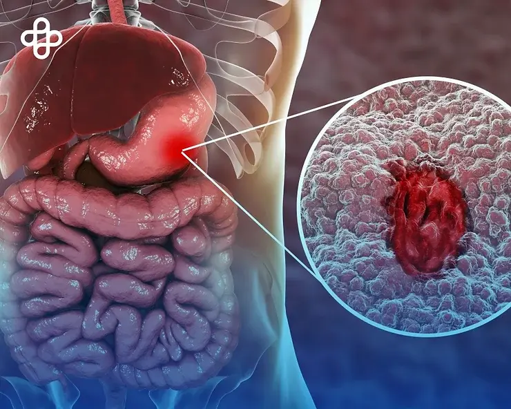 Gastritis: Guía Completa de Diagnóstico y Tratamiento para Aliviar los Síntomas y Prevenir Complicaciones