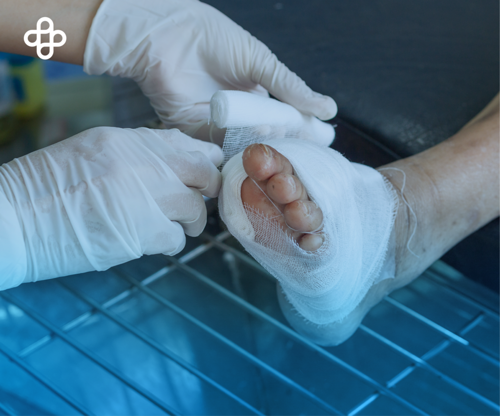 Tratamiento del Pie Diabético: Estrategias Avanzadas para Cuidar y Sanar. ¡Descubre los Avances en Centro Médico Eternal y su Enfoque Revolucionario con Células Madre!