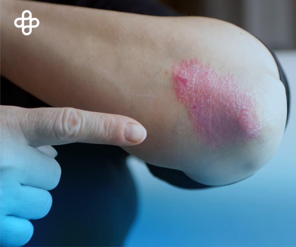 Desvelando los Secretos de la Psoriasis: Cómo las Células Madre Ofrecen Nuevas Perspectivas