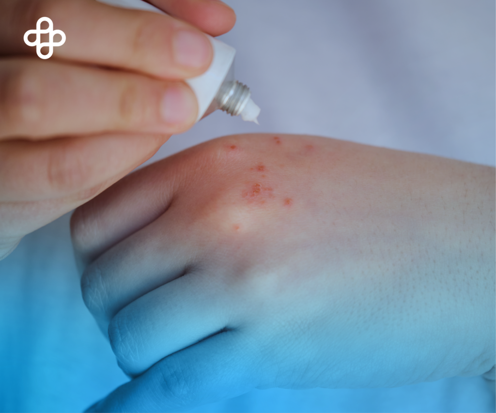 Prevención de la Psoriasis